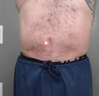 Man's torso with hairy abdomen and red laser dot near navel, wearing blue drawstring pants and partial arm tattoo.